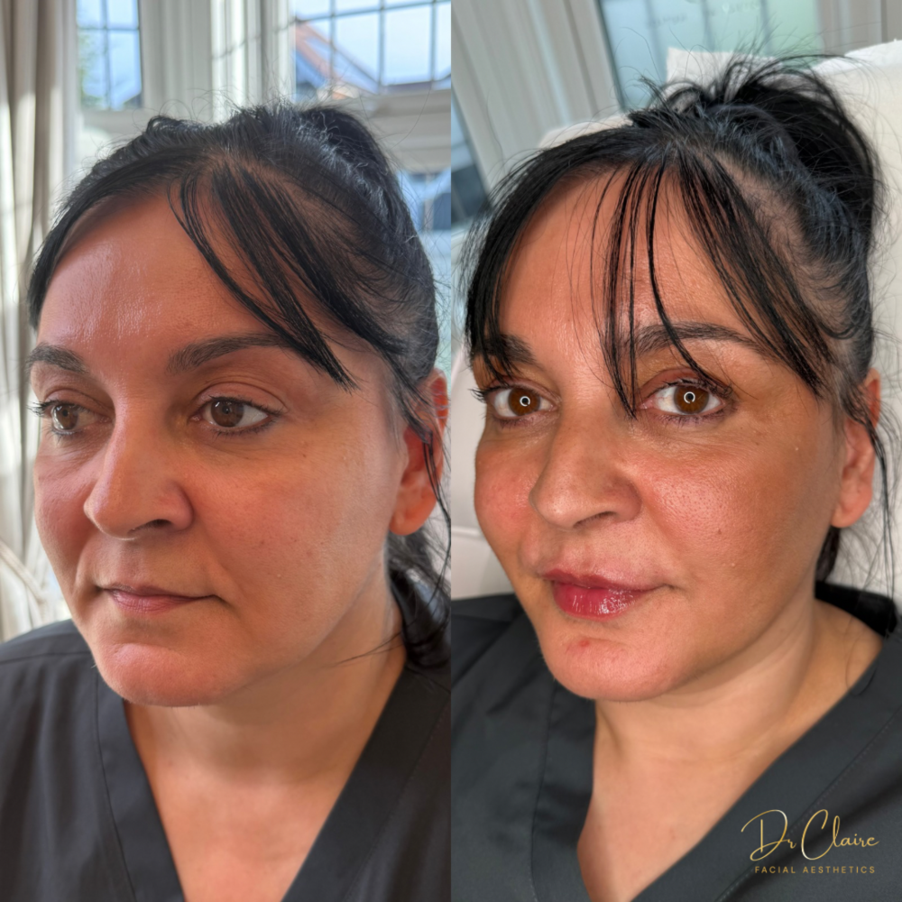 Transformations | Dr Claire Facial Aesthetics | Botox Chorley | Fillers Chorley | Aesthetics Chorley | Botox Treatments Chorley | Dermal Fillers Chorley | Aesthetic Enhancements Chorley