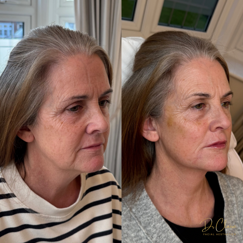 Transformations | Dr Claire Facial Aesthetics | Botox Chorley | Fillers Chorley | Aesthetics Chorley | Botox Treatments Chorley | Dermal Fillers Chorley | Aesthetic Enhancements Chorley