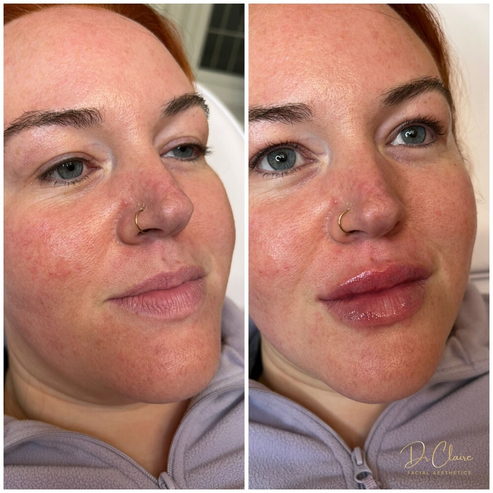 Transformations | Dr Claire Facial Aesthetics | Botox Chorley | Fillers Chorley | Aesthetics Chorley | Botox Treatments Chorley | Dermal Fillers Chorley | Aesthetic Enhancements Chorley