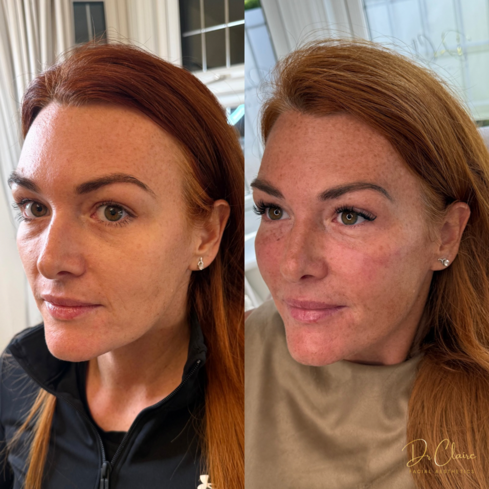Transformations | Dr Claire Facial Aesthetics | Botox Chorley | Fillers Chorley | Aesthetics Chorley | Botox Treatments Chorley | Dermal Fillers Chorley | Aesthetic Enhancements Chorley