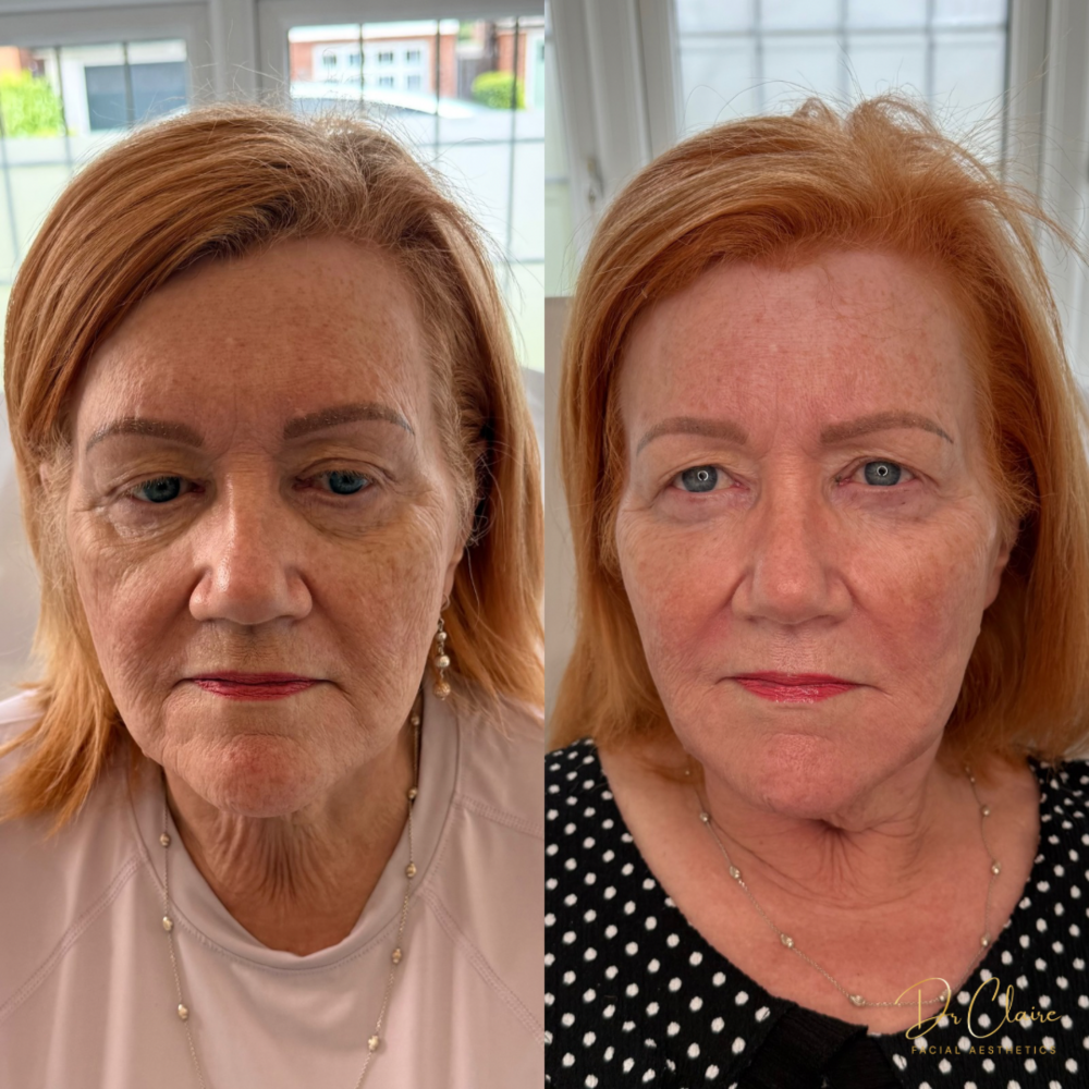 Transformations | Dr Claire Facial Aesthetics | Botox Chorley | Fillers Chorley | Aesthetics Chorley | Botox Treatments Chorley | Dermal Fillers Chorley | Aesthetic Enhancements Chorley