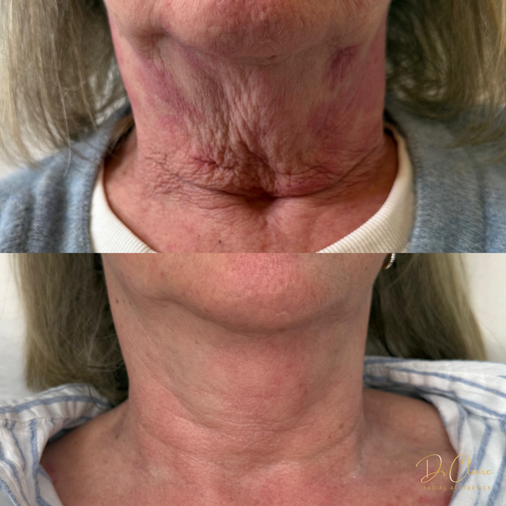 Transformations | Dr Claire Facial Aesthetics | Botox Chorley | Fillers Chorley | Aesthetics Chorley | Botox Treatments Chorley | Dermal Fillers Chorley | Aesthetic Enhancements Chorley