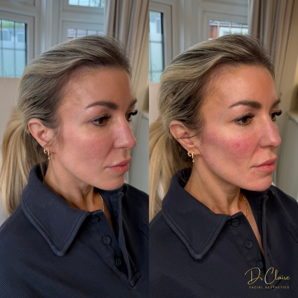 Transformations | Dr Claire Facial Aesthetics | Botox Chorley | Fillers Chorley | Aesthetics Chorley | Botox Treatments Chorley | Dermal Fillers Chorley | Aesthetic Enhancements Chorley