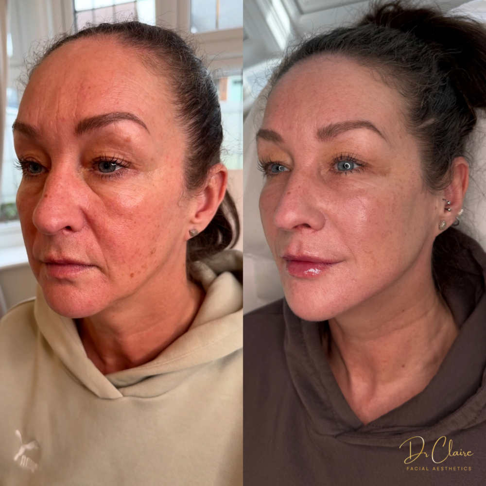 Transformations | Dr Claire Facial Aesthetics | Botox Chorley | Fillers Chorley | Aesthetics Chorley | Botox Treatments Chorley | Dermal Fillers Chorley | Aesthetic Enhancements Chorley