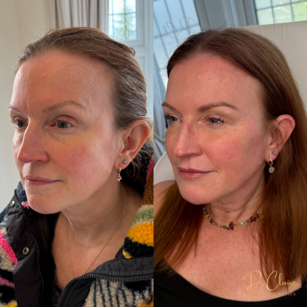 Transformations | Dr Claire Facial Aesthetics | Botox Chorley | Fillers Chorley | Aesthetics Chorley | Botox Treatments Chorley | Dermal Fillers Chorley | Aesthetic Enhancements Chorley
