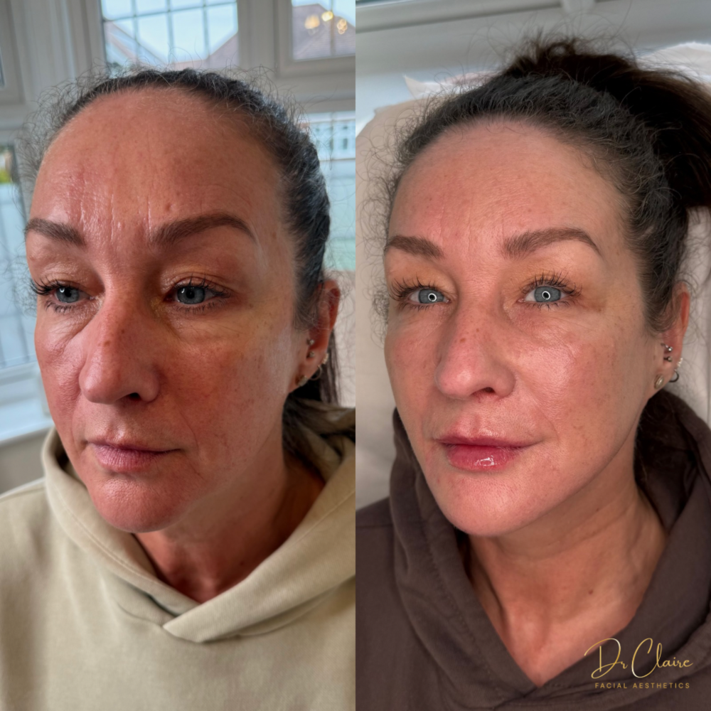 Transformations | Dr Claire Facial Aesthetics | Botox Chorley | Fillers Chorley | Aesthetics Chorley | Botox Treatments Chorley | Dermal Fillers Chorley | Aesthetic Enhancements Chorley