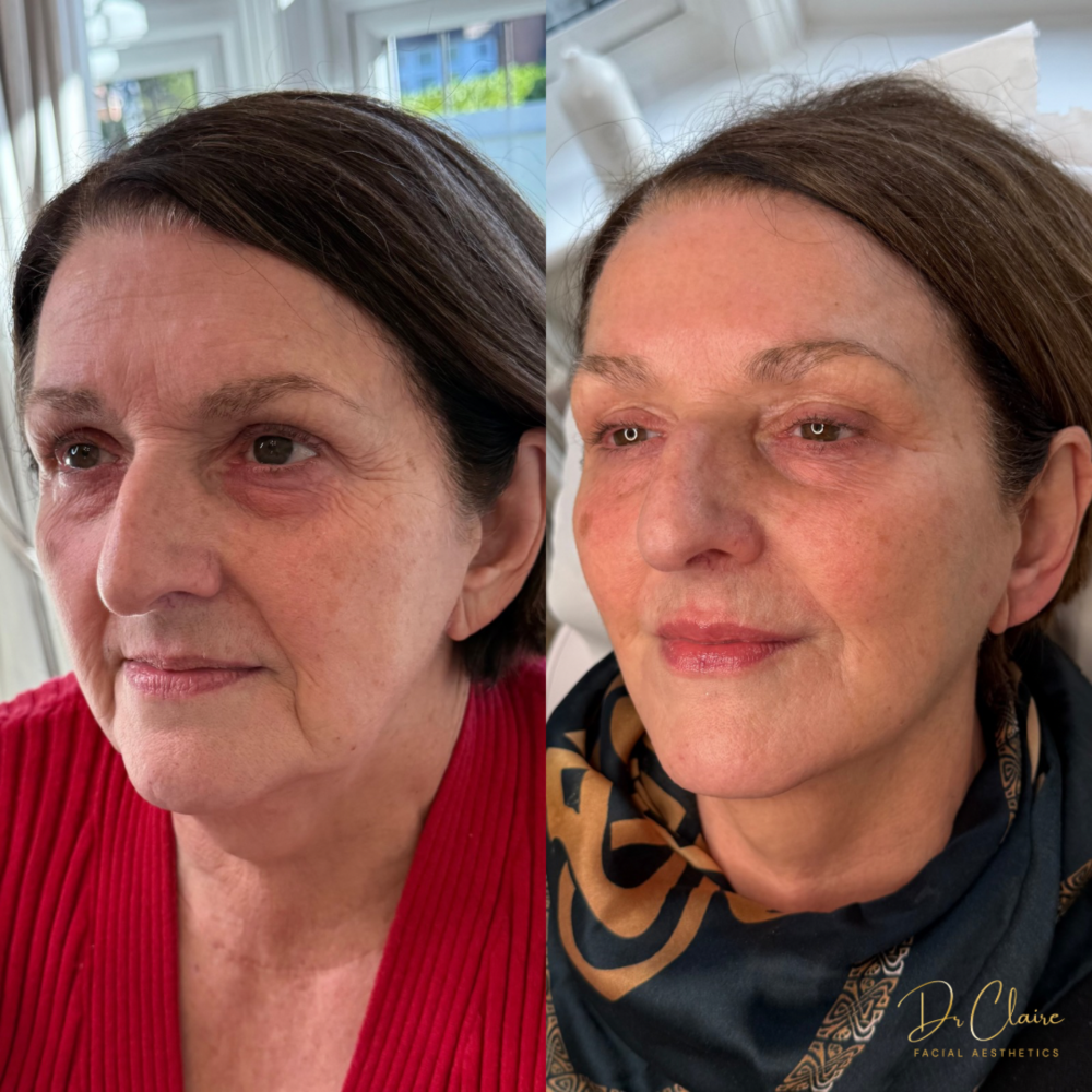 Transformations | Dr Claire Facial Aesthetics | Botox Chorley | Fillers Chorley | Aesthetics Chorley | Botox Treatments Chorley | Dermal Fillers Chorley | Aesthetic Enhancements Chorley