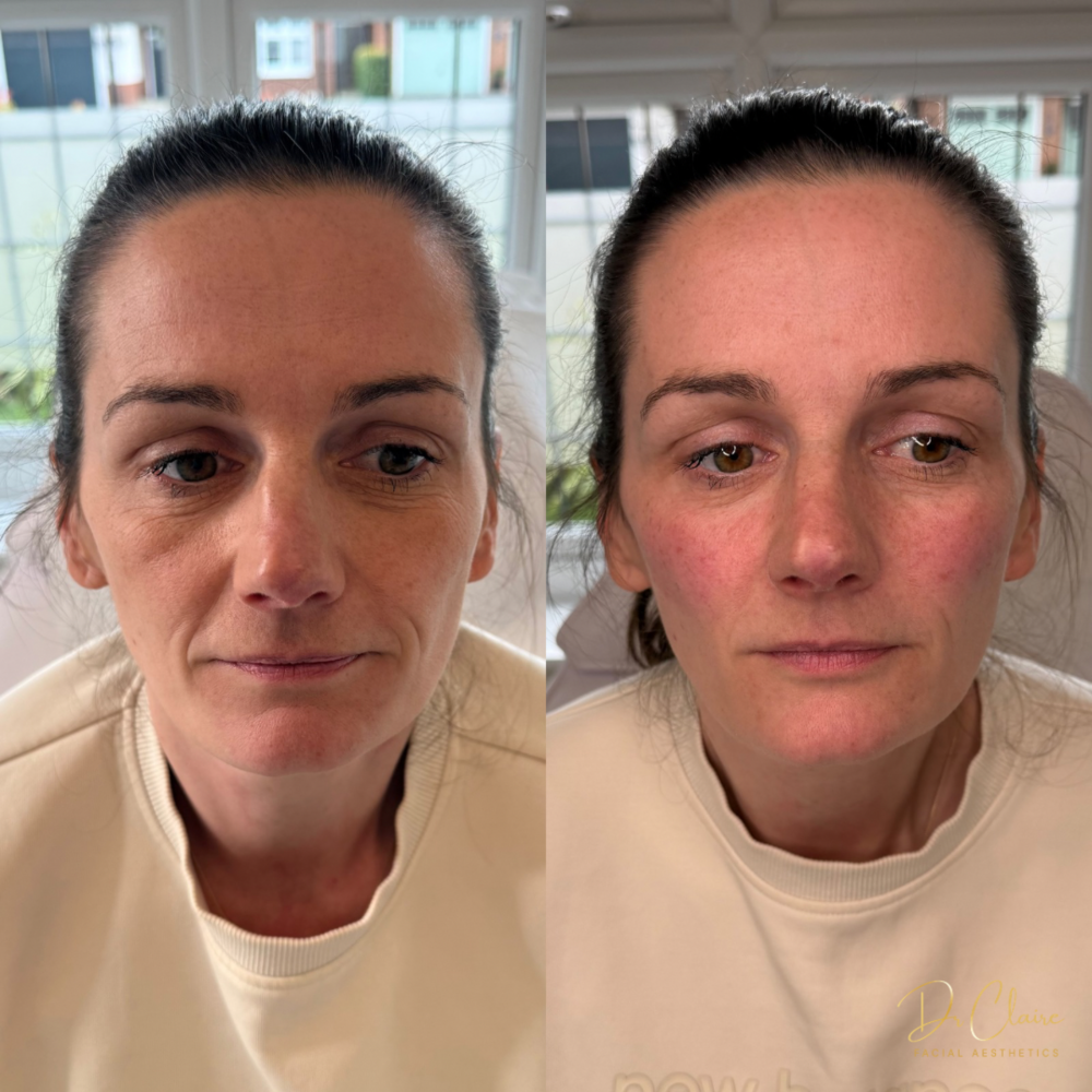 Transformations | Dr Claire Facial Aesthetics | Botox Chorley | Fillers Chorley | Aesthetics Chorley | Botox Treatments Chorley | Dermal Fillers Chorley | Aesthetic Enhancements Chorley