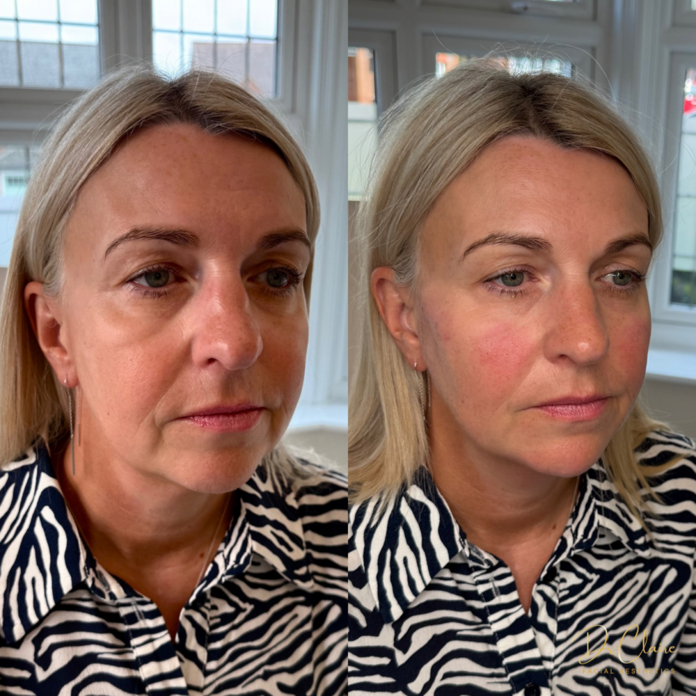 Transformations | Dr Claire Facial Aesthetics | Botox Chorley | Fillers Chorley | Aesthetics Chorley | Botox Treatments Chorley | Dermal Fillers Chorley | Aesthetic Enhancements Chorley