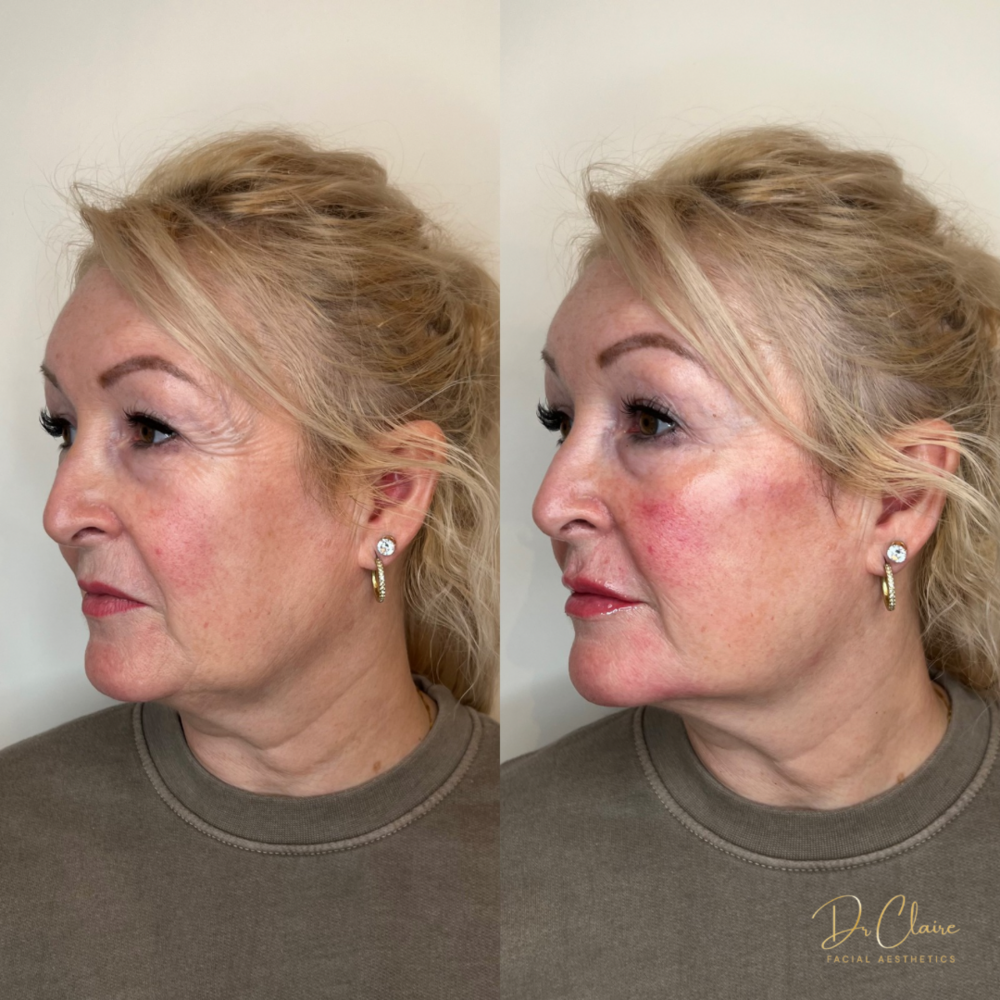 Transformations | Dr Claire Facial Aesthetics | Botox Chorley | Fillers Chorley | Aesthetics Chorley | Botox Treatments Chorley | Dermal Fillers Chorley | Aesthetic Enhancements Chorley