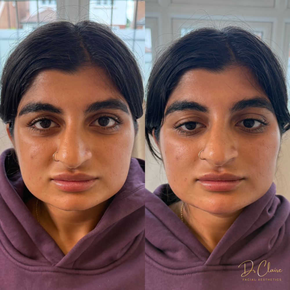 Transformations | Dr Claire Facial Aesthetics | Botox Chorley | Fillers Chorley | Aesthetics Chorley | Botox Treatments Chorley | Dermal Fillers Chorley | Aesthetic Enhancements Chorley