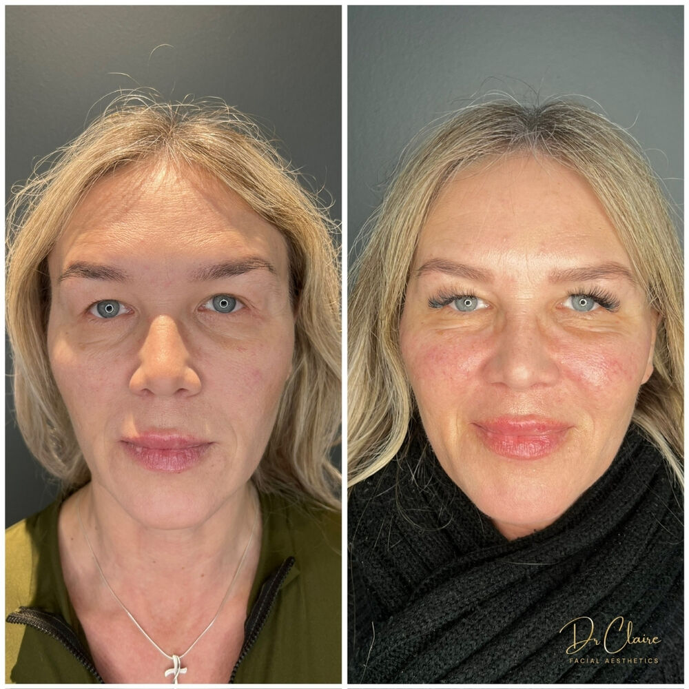 Transformations | Dr Claire Facial Aesthetics | Botox Chorley | Fillers Chorley | Aesthetics Chorley | Botox Treatments Chorley | Dermal Fillers Chorley | Aesthetic Enhancements Chorley