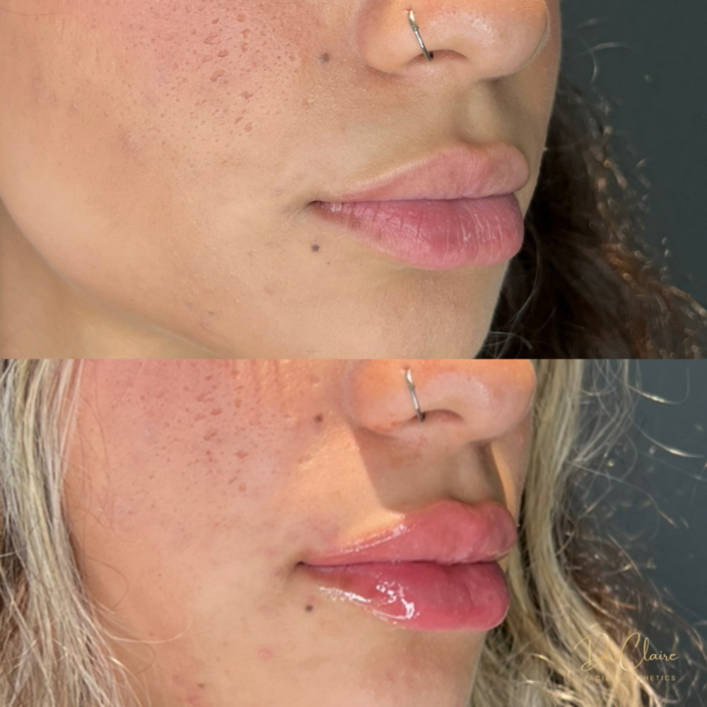 Transformations | Dr Claire Facial Aesthetics | Botox Chorley | Fillers Chorley | Aesthetics Chorley | Botox Treatments Chorley | Dermal Fillers Chorley | Aesthetic Enhancements Chorley