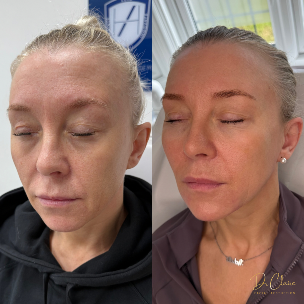Transformations | Dr Claire Facial Aesthetics | Botox Chorley | Fillers Chorley | Aesthetics Chorley | Botox Treatments Chorley | Dermal Fillers Chorley | Aesthetic Enhancements Chorley