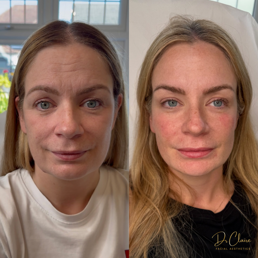 Transformations | Dr Claire Facial Aesthetics | Botox Chorley | Fillers Chorley | Aesthetics Chorley | Botox Treatments Chorley | Dermal Fillers Chorley | Aesthetic Enhancements Chorley