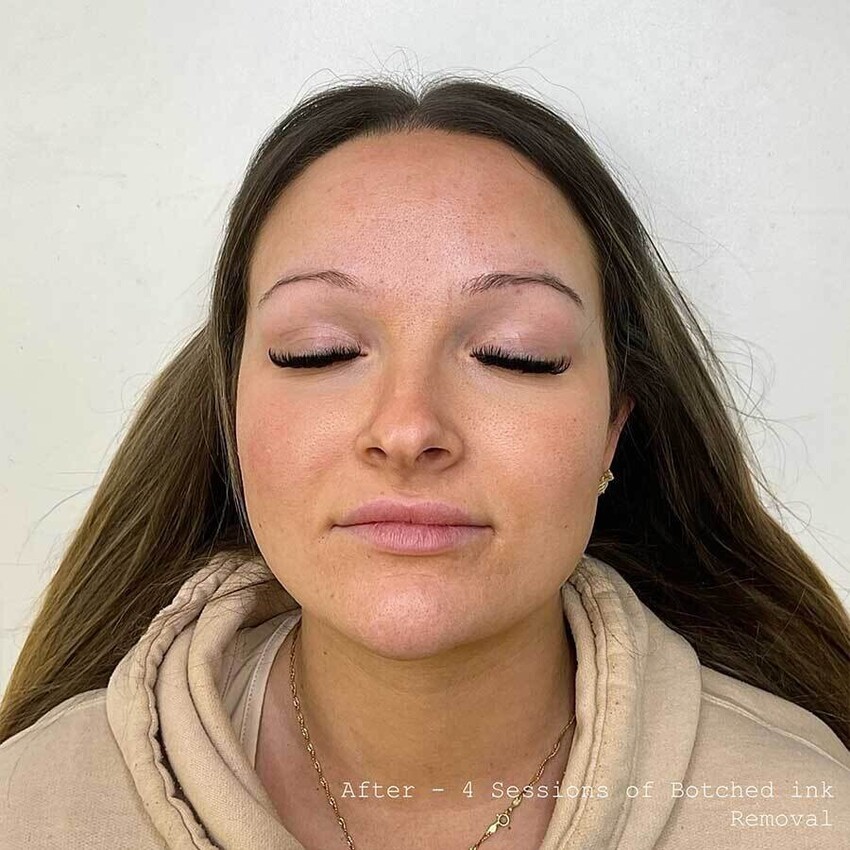 Tattoo Removal - Botched Ink