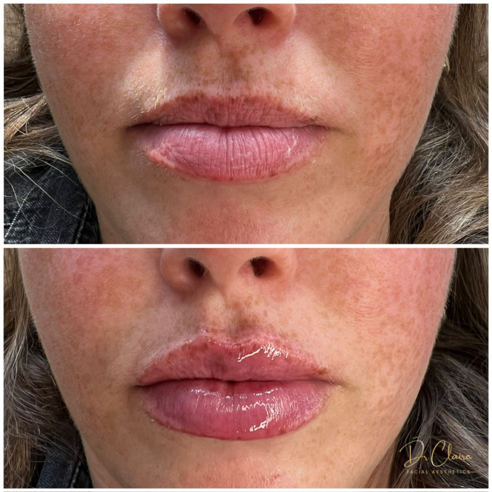 Transformations | Dr Claire Facial Aesthetics | Botox Chorley | Fillers Chorley | Aesthetics Chorley | Botox Treatments Chorley | Dermal Fillers Chorley | Aesthetic Enhancements Chorley