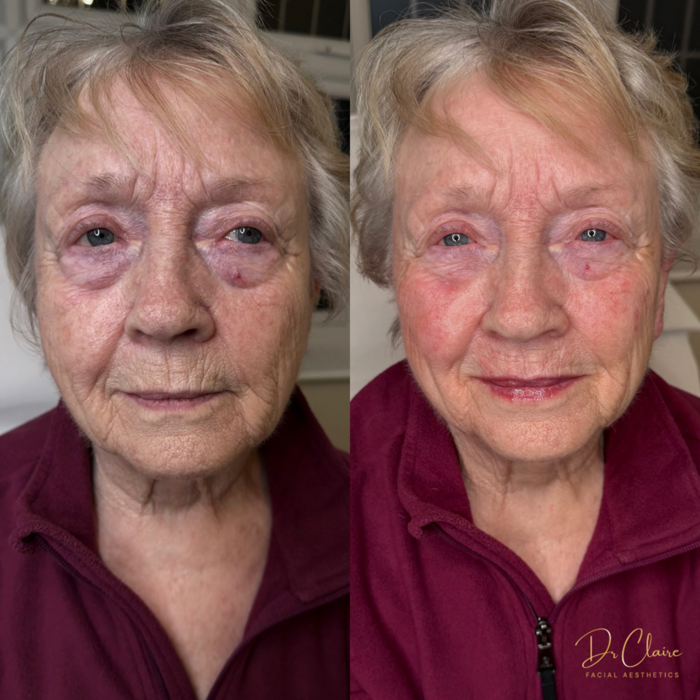 Transformations | Dr Claire Facial Aesthetics | Botox Chorley | Fillers Chorley | Aesthetics Chorley | Botox Treatments Chorley | Dermal Fillers Chorley | Aesthetic Enhancements Chorley