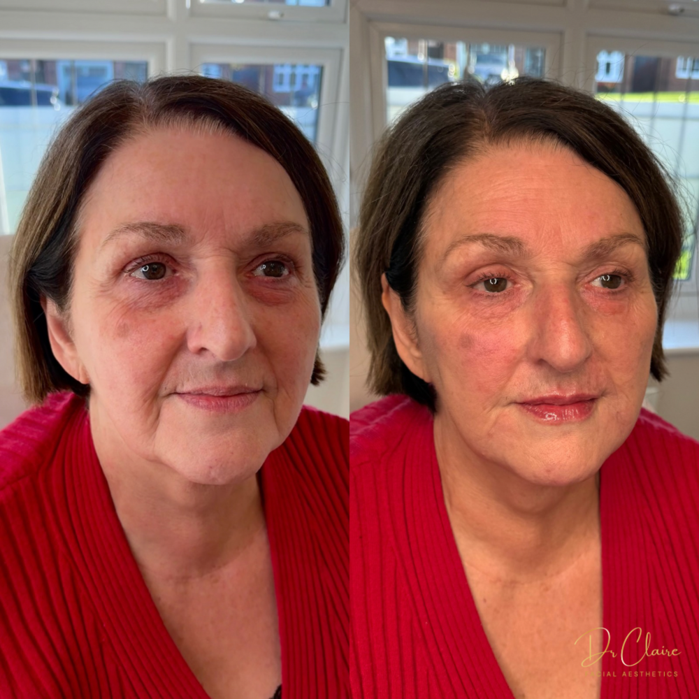 Transformations | Dr Claire Facial Aesthetics | Botox Chorley | Fillers Chorley | Aesthetics Chorley | Botox Treatments Chorley | Dermal Fillers Chorley | Aesthetic Enhancements Chorley