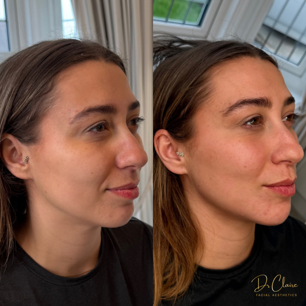 Transformations | Dr Claire Facial Aesthetics | Botox Chorley | Fillers Chorley | Aesthetics Chorley | Botox Treatments Chorley | Dermal Fillers Chorley | Aesthetic Enhancements Chorley