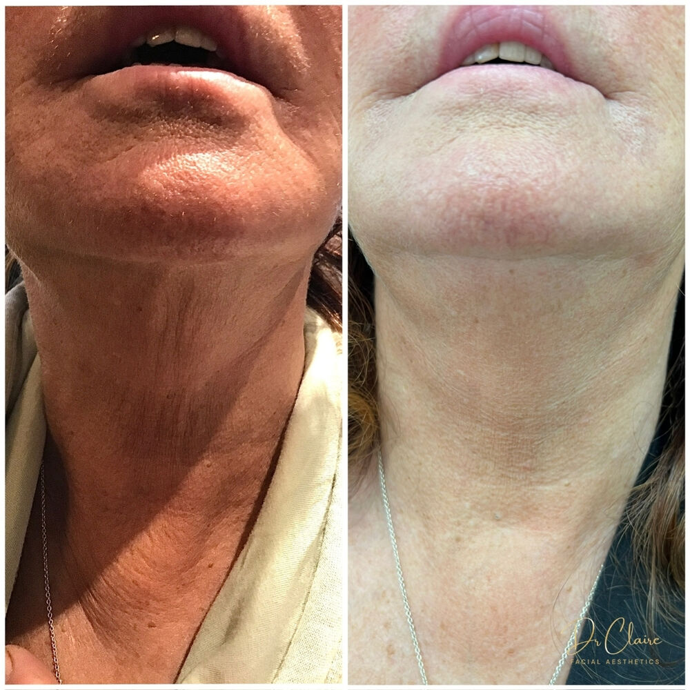 Transformations | Dr Claire Facial Aesthetics | Botox Chorley | Fillers Chorley | Aesthetics Chorley | Botox Treatments Chorley | Dermal Fillers Chorley | Aesthetic Enhancements Chorley