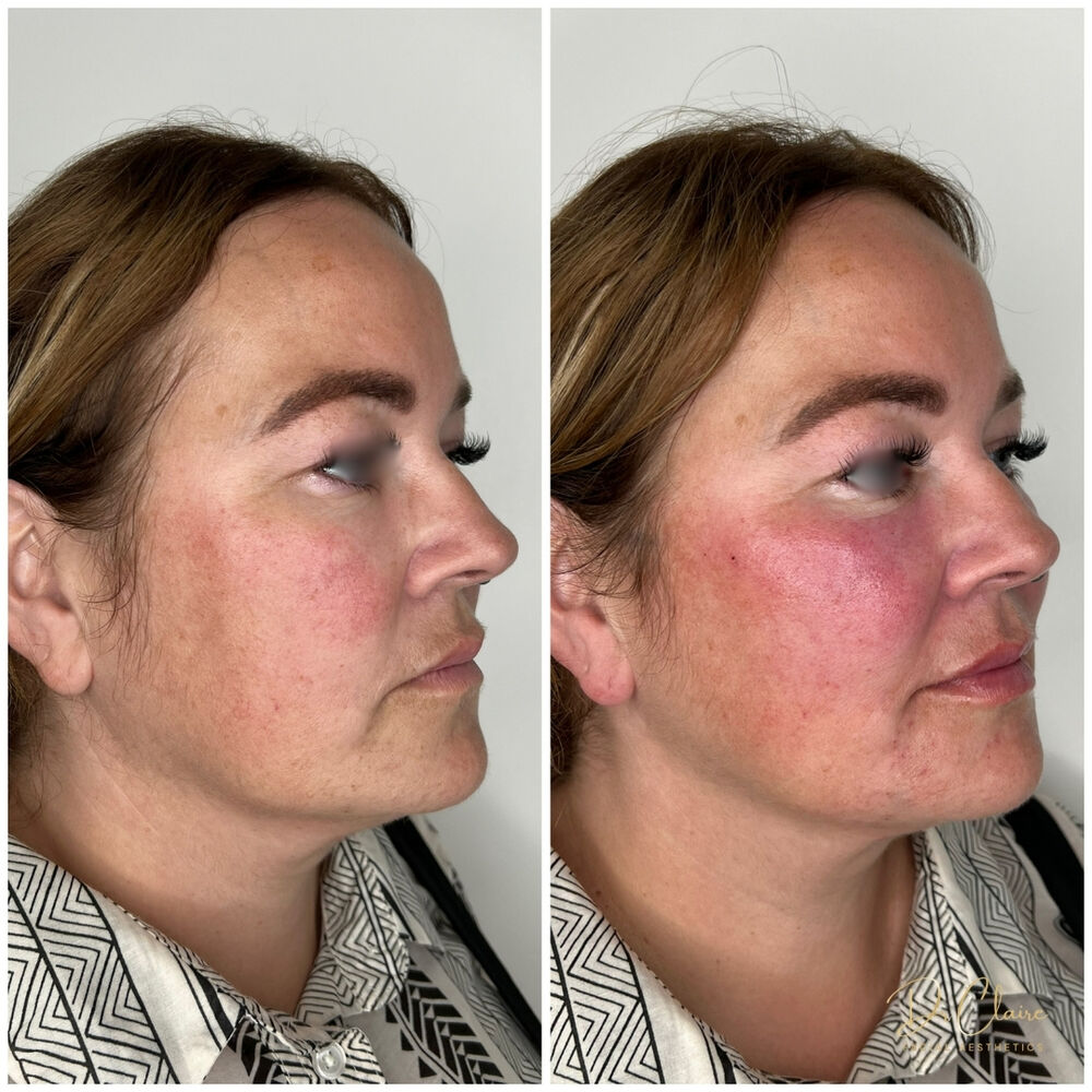 Transformations | Dr Claire Facial Aesthetics | Botox Chorley | Fillers Chorley | Aesthetics Chorley | Botox Treatments Chorley | Dermal Fillers Chorley | Aesthetic Enhancements Chorley