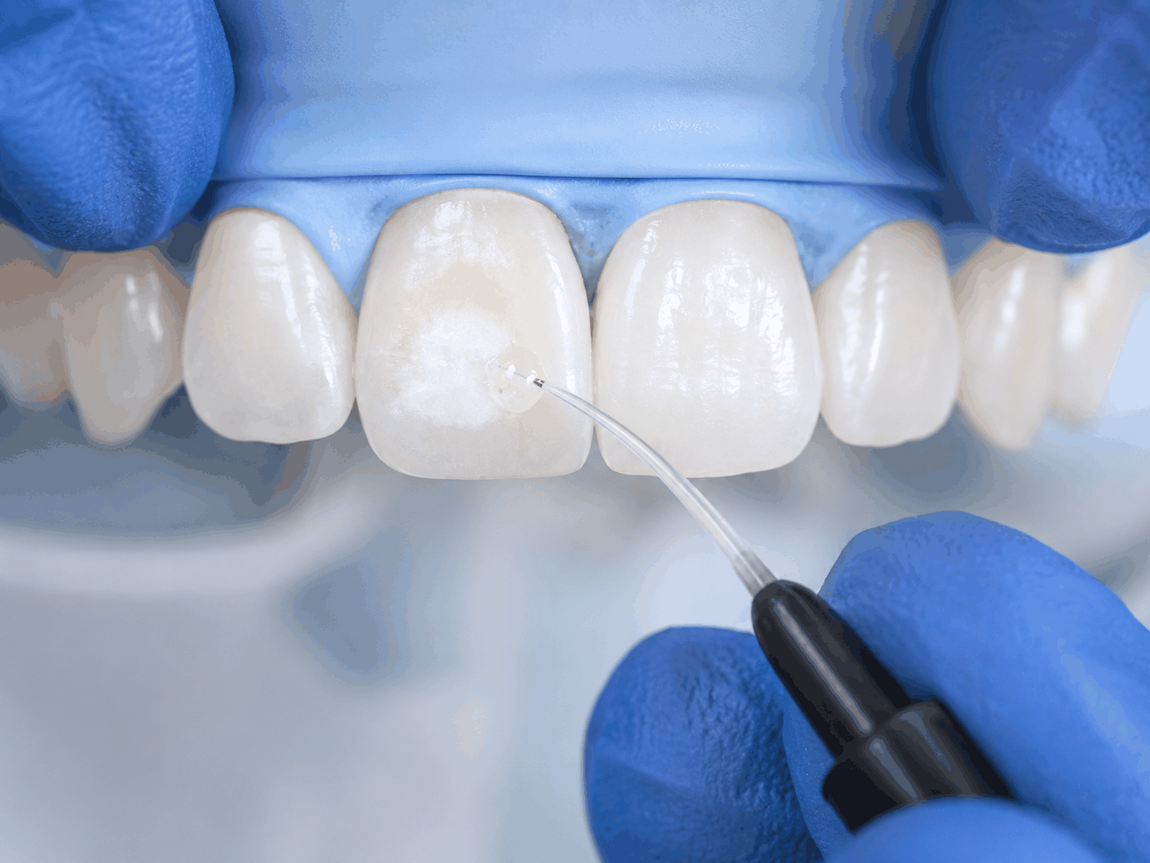 ICON® White Spot Removal | Cramond House Dental Practice | Dentist Clitheroe Preston Manchester | Dental Implants Clitheroe Preston Manchester | Gum Surgery Clitheroe Preston Manchester