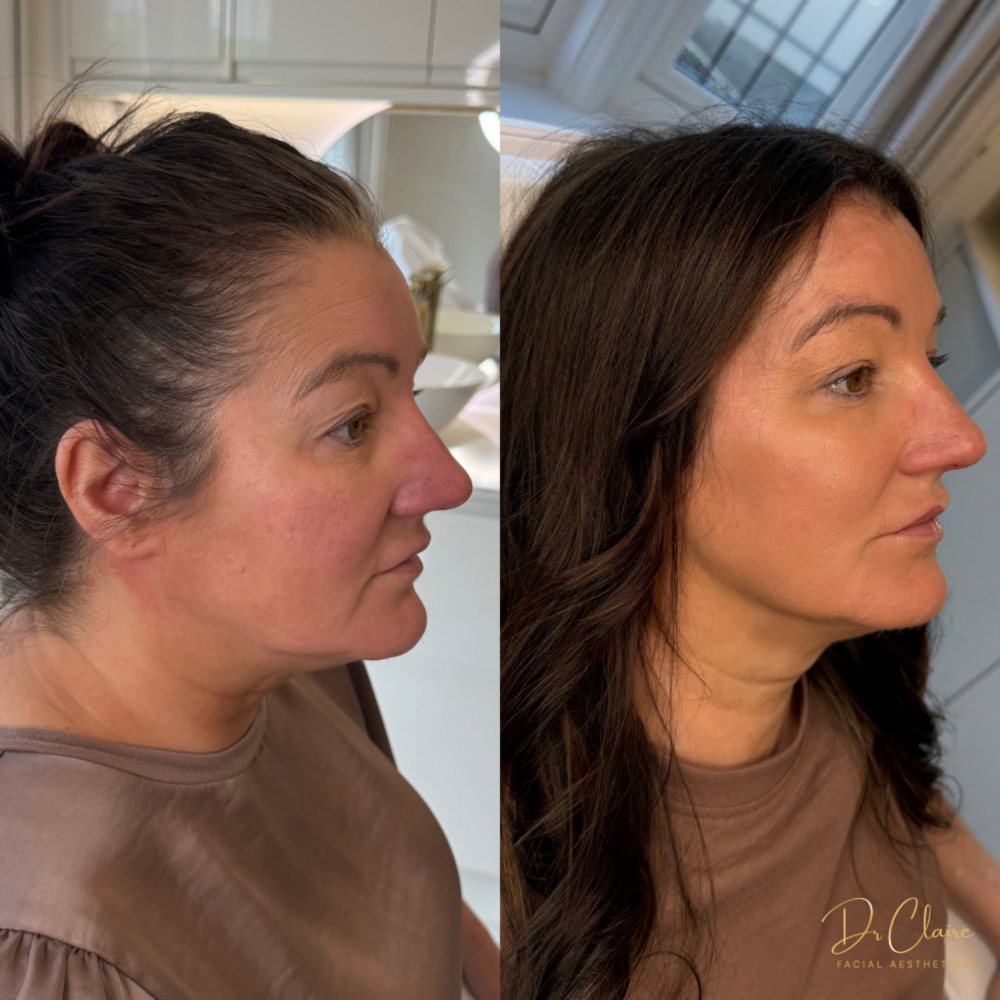 Transformations | Dr Claire Facial Aesthetics | Botox Chorley | Fillers Chorley | Aesthetics Chorley | Botox Treatments Chorley | Dermal Fillers Chorley | Aesthetic Enhancements Chorley