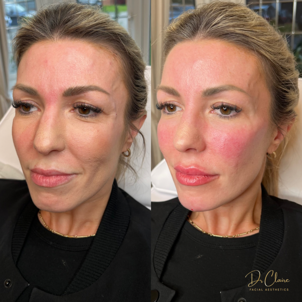 Transformations | Dr Claire Facial Aesthetics | Botox Chorley | Fillers Chorley | Aesthetics Chorley | Botox Treatments Chorley | Dermal Fillers Chorley | Aesthetic Enhancements Chorley