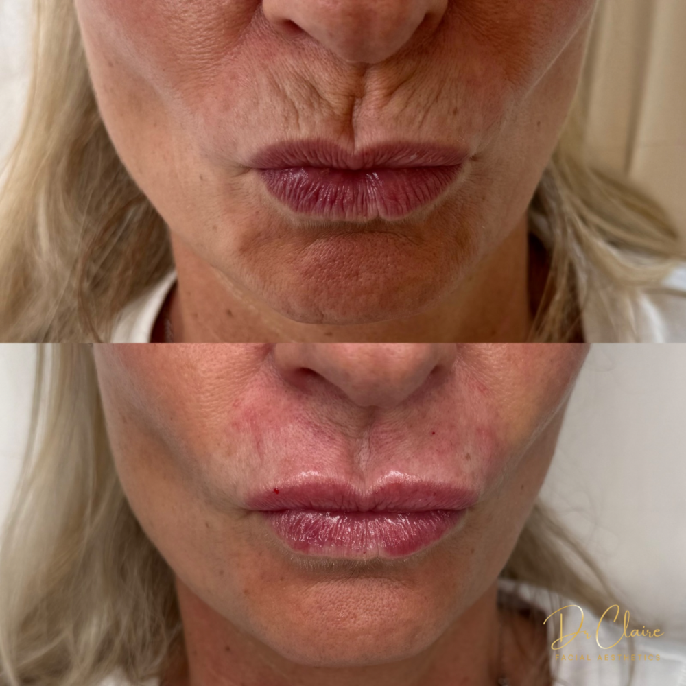 Transformations | Dr Claire Facial Aesthetics | Botox Chorley | Fillers Chorley | Aesthetics Chorley | Botox Treatments Chorley | Dermal Fillers Chorley | Aesthetic Enhancements Chorley