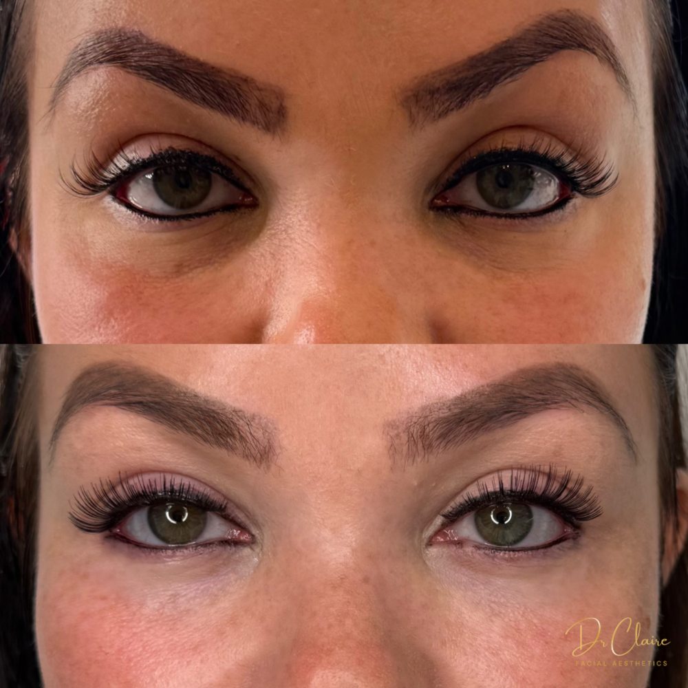 Transformations | Dr Claire Facial Aesthetics | Botox Chorley | Fillers Chorley | Aesthetics Chorley | Botox Treatments Chorley | Dermal Fillers Chorley | Aesthetic Enhancements Chorley