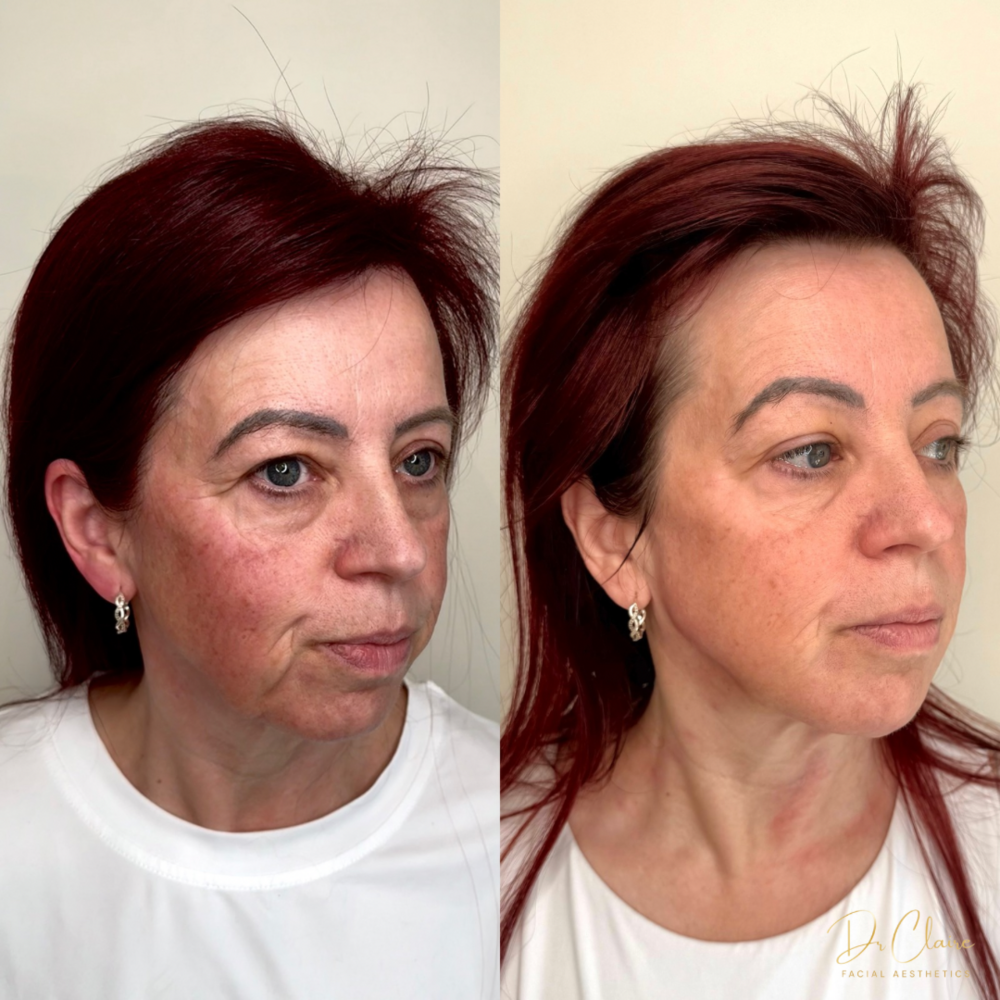 Transformations | Dr Claire Facial Aesthetics | Botox Chorley | Fillers Chorley | Aesthetics Chorley | Botox Treatments Chorley | Dermal Fillers Chorley | Aesthetic Enhancements Chorley