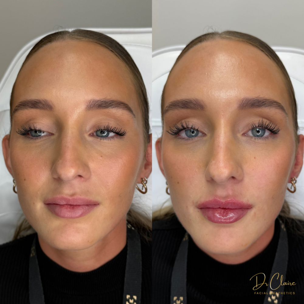 Transformations | Dr Claire Facial Aesthetics | Botox Chorley | Fillers Chorley | Aesthetics Chorley | Botox Treatments Chorley | Dermal Fillers Chorley | Aesthetic Enhancements Chorley