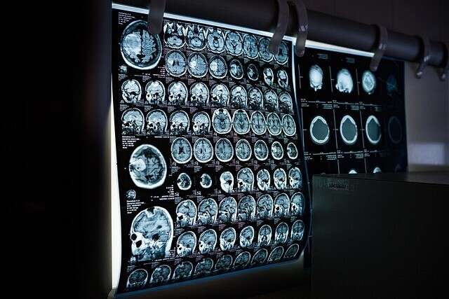 image of a parkinsons brain scan