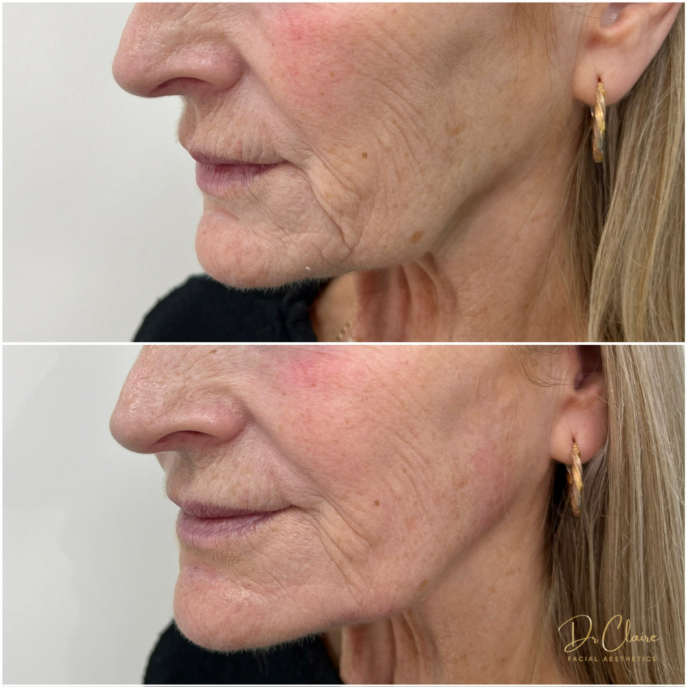 Transformations | Dr Claire Facial Aesthetics | Botox Chorley | Fillers Chorley | Aesthetics Chorley | Botox Treatments Chorley | Dermal Fillers Chorley | Aesthetic Enhancements Chorley