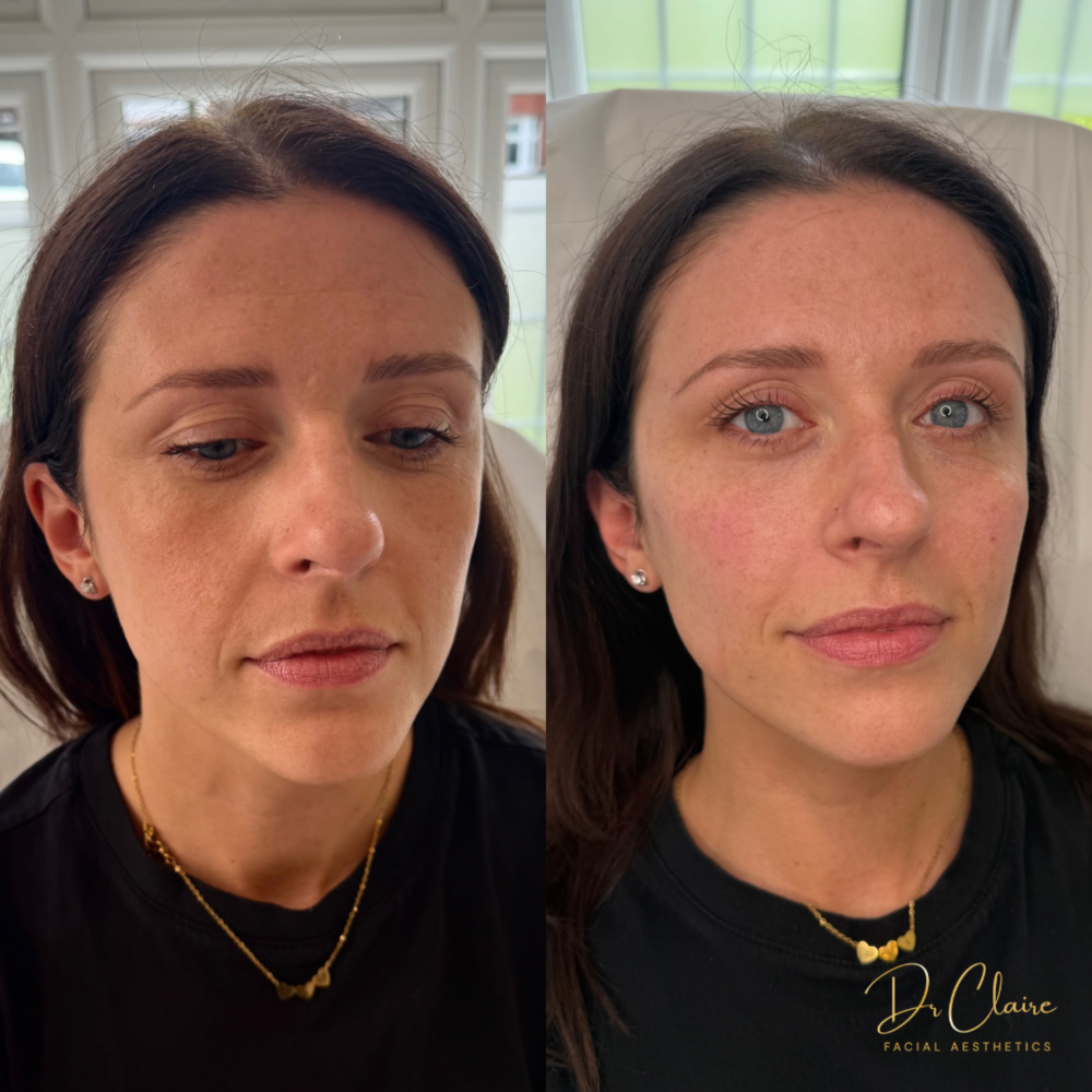 Transformations | Dr Claire Facial Aesthetics | Botox Chorley | Fillers Chorley | Aesthetics Chorley | Botox Treatments Chorley | Dermal Fillers Chorley | Aesthetic Enhancements Chorley