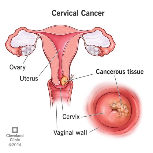 Cervical Cancer Prevention 
