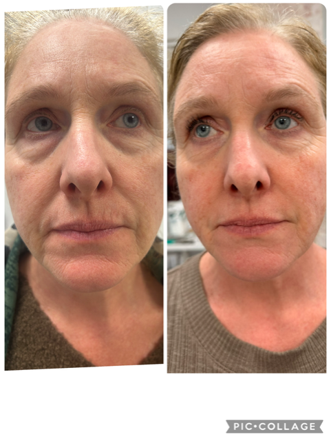 Before &amp; After | Clk medical aesthetics