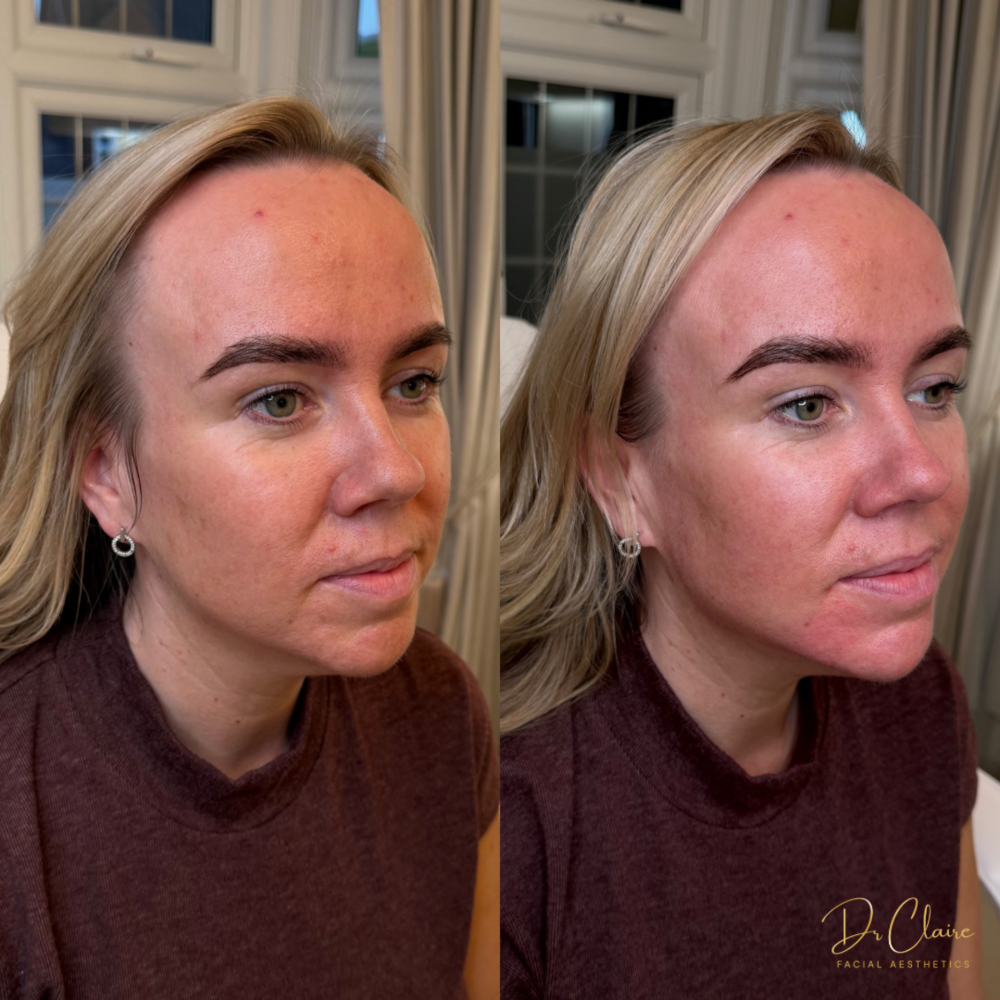 Transformations | Dr Claire Facial Aesthetics | Botox Chorley | Fillers Chorley | Aesthetics Chorley | Botox Treatments Chorley | Dermal Fillers Chorley | Aesthetic Enhancements Chorley