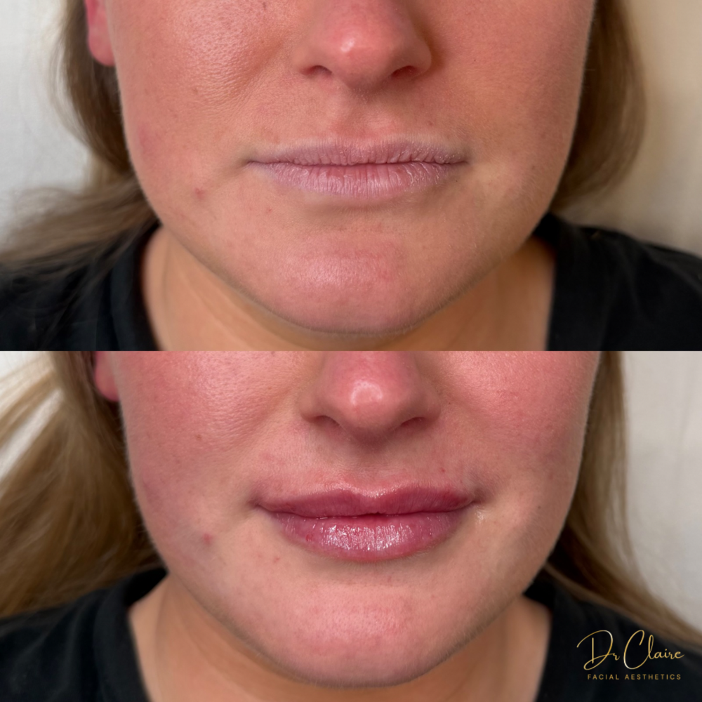 Transformations | Dr Claire Facial Aesthetics | Botox Chorley | Fillers Chorley | Aesthetics Chorley | Botox Treatments Chorley | Dermal Fillers Chorley | Aesthetic Enhancements Chorley