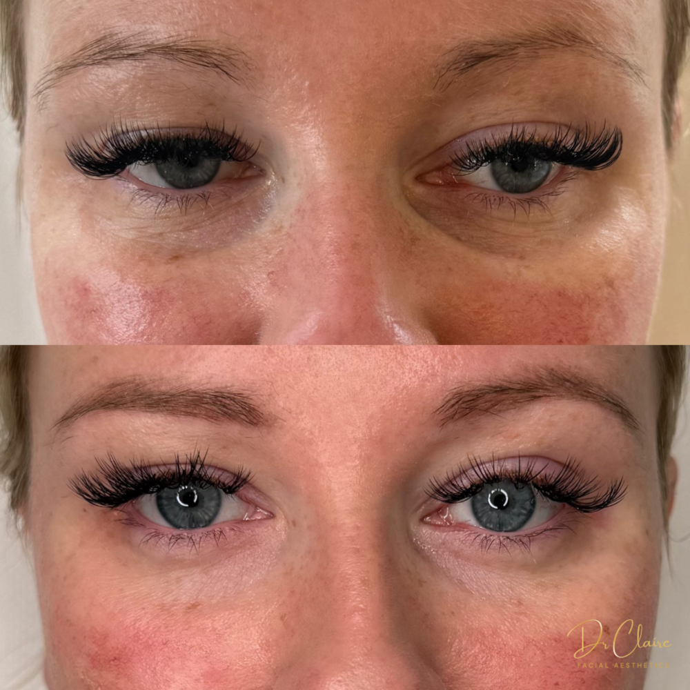 Transformations | Dr Claire Facial Aesthetics | Botox Chorley | Fillers Chorley | Aesthetics Chorley | Botox Treatments Chorley | Dermal Fillers Chorley | Aesthetic Enhancements Chorley