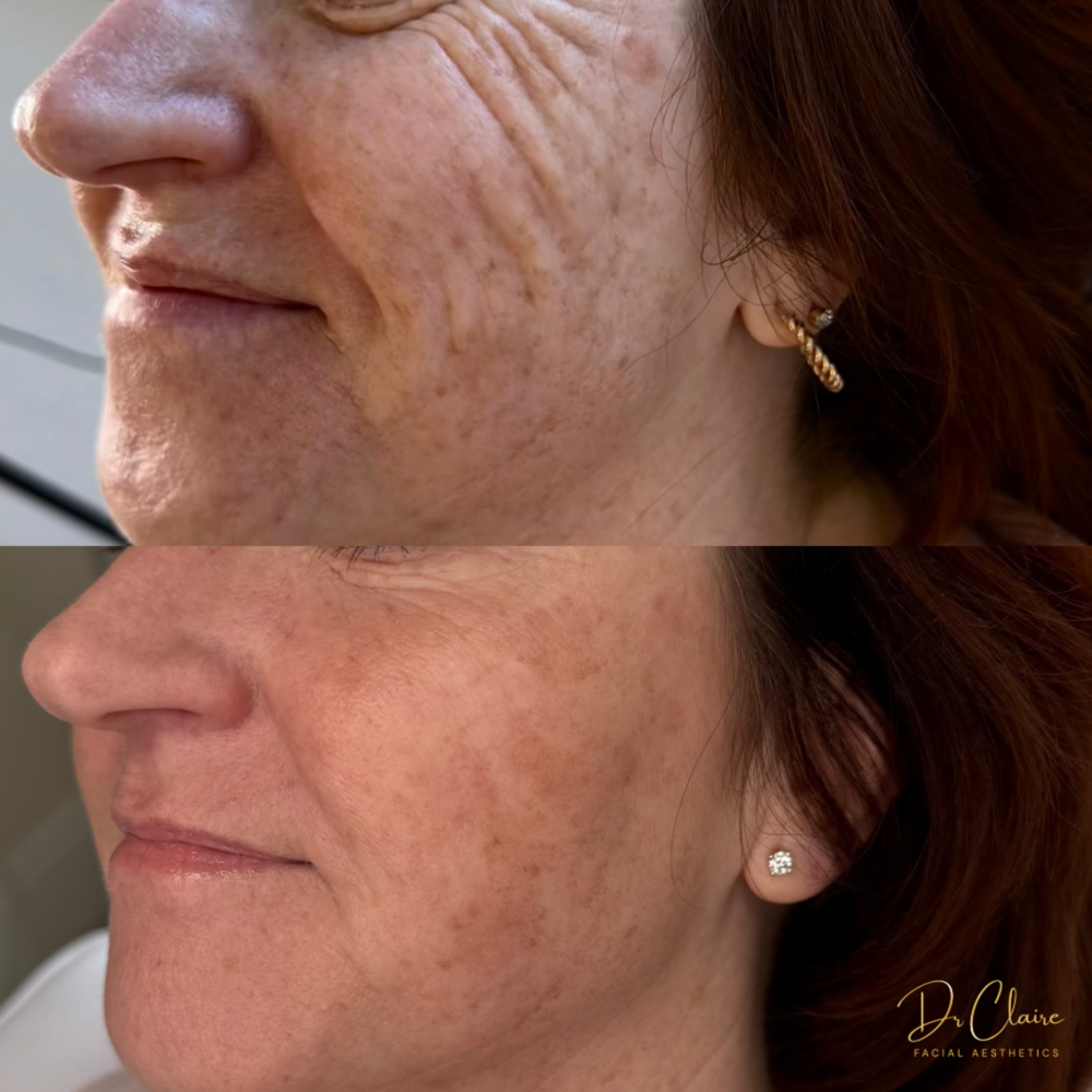 Transformations | Dr Claire Facial Aesthetics | Botox Chorley | Fillers Chorley | Aesthetics Chorley | Botox Treatments Chorley | Dermal Fillers Chorley | Aesthetic Enhancements Chorley