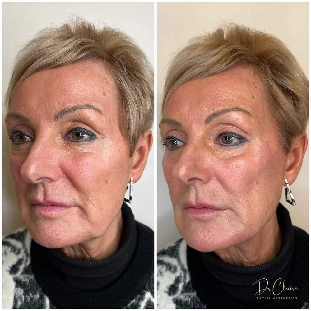 Transformations | Dr Claire Facial Aesthetics | Botox Chorley | Fillers Chorley | Aesthetics Chorley | Botox Treatments Chorley | Dermal Fillers Chorley | Aesthetic Enhancements Chorley