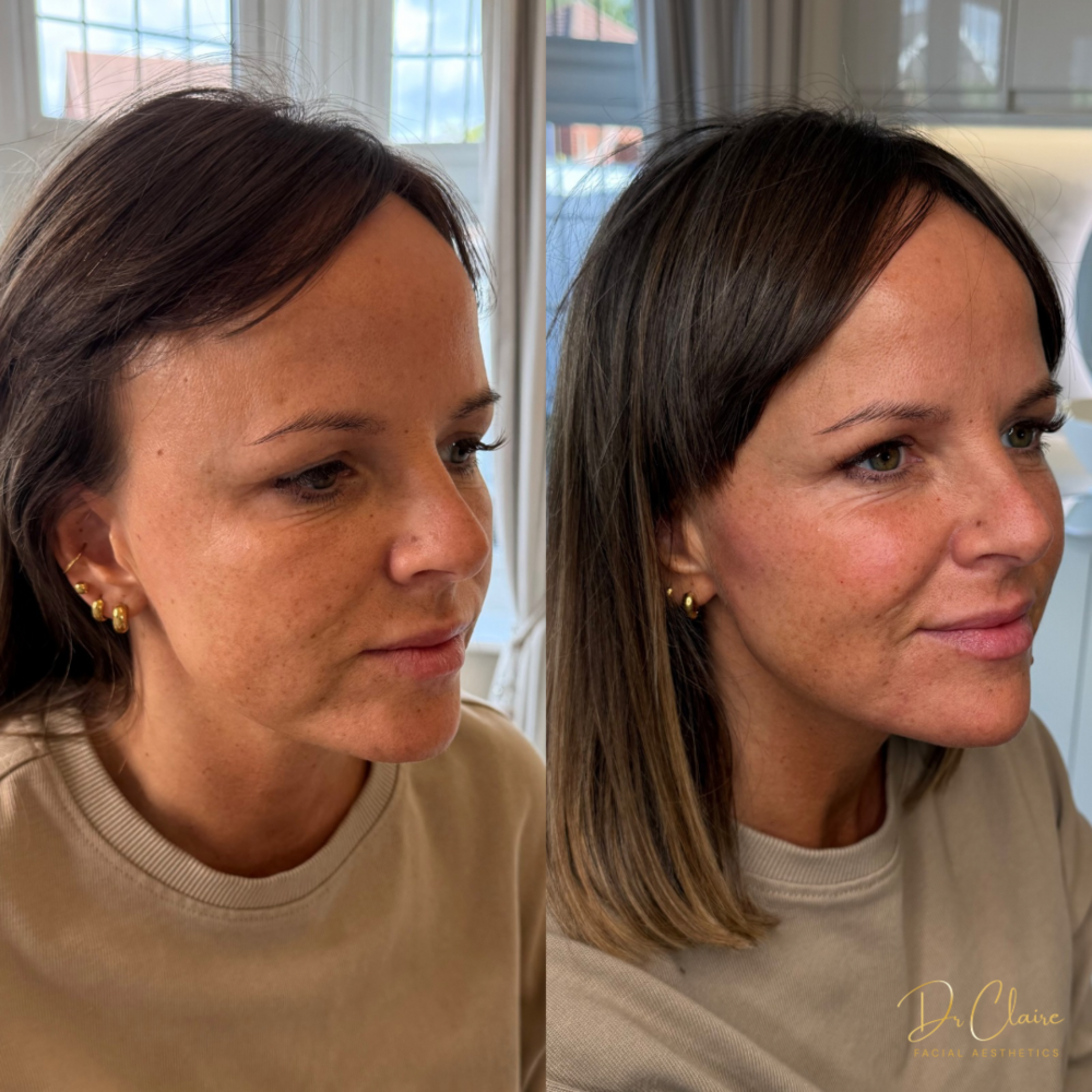 Transformations | Dr Claire Facial Aesthetics | Botox Chorley | Fillers Chorley | Aesthetics Chorley | Botox Treatments Chorley | Dermal Fillers Chorley | Aesthetic Enhancements Chorley