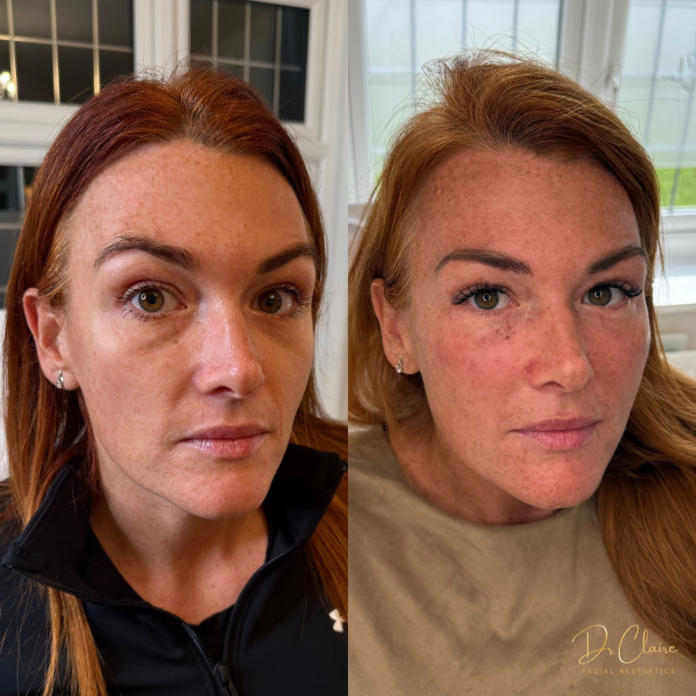 Transformations | Dr Claire Facial Aesthetics | Botox Chorley | Fillers Chorley | Aesthetics Chorley | Botox Treatments Chorley | Dermal Fillers Chorley | Aesthetic Enhancements Chorley