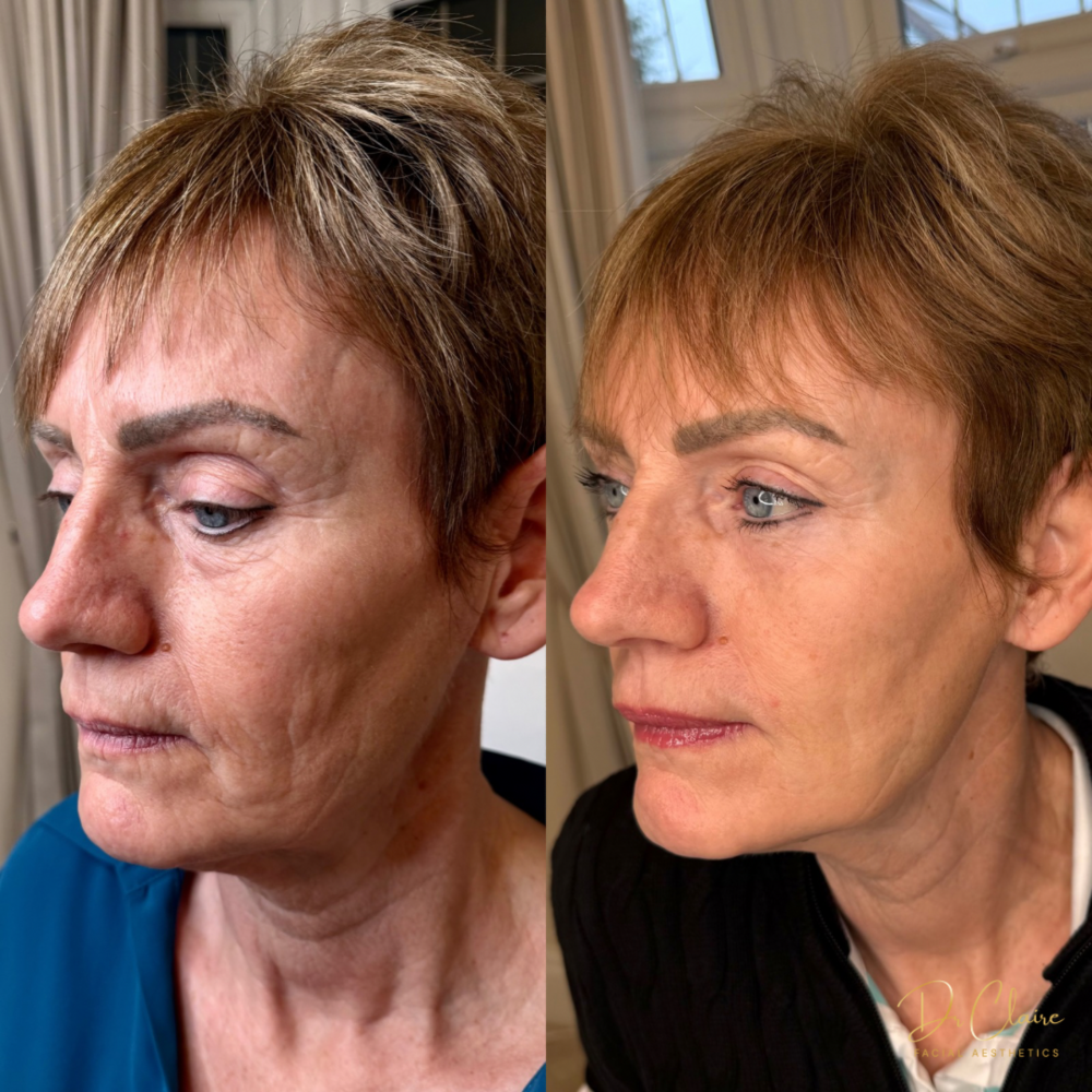 Transformations | Dr Claire Facial Aesthetics | Botox Chorley | Fillers Chorley | Aesthetics Chorley | Botox Treatments Chorley | Dermal Fillers Chorley | Aesthetic Enhancements Chorley
