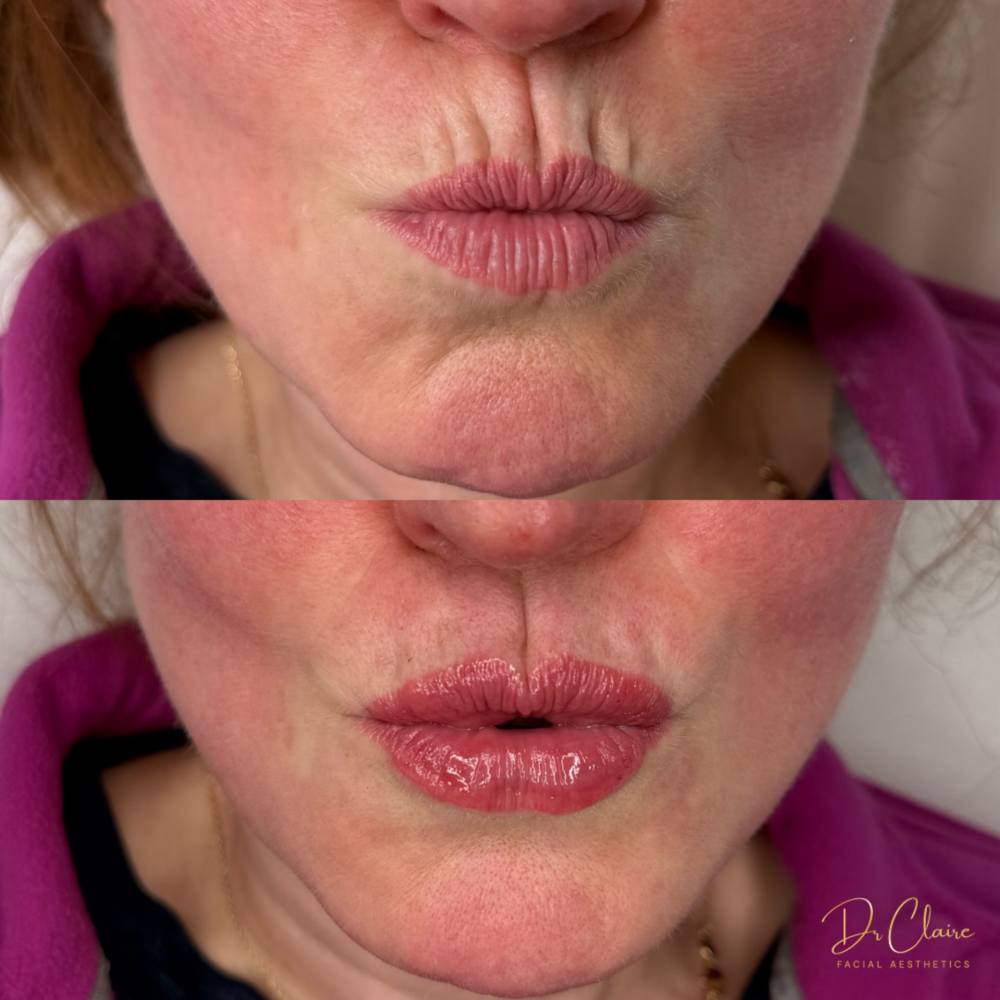 Transformations | Dr Claire Facial Aesthetics | Botox Chorley | Fillers Chorley | Aesthetics Chorley | Botox Treatments Chorley | Dermal Fillers Chorley | Aesthetic Enhancements Chorley