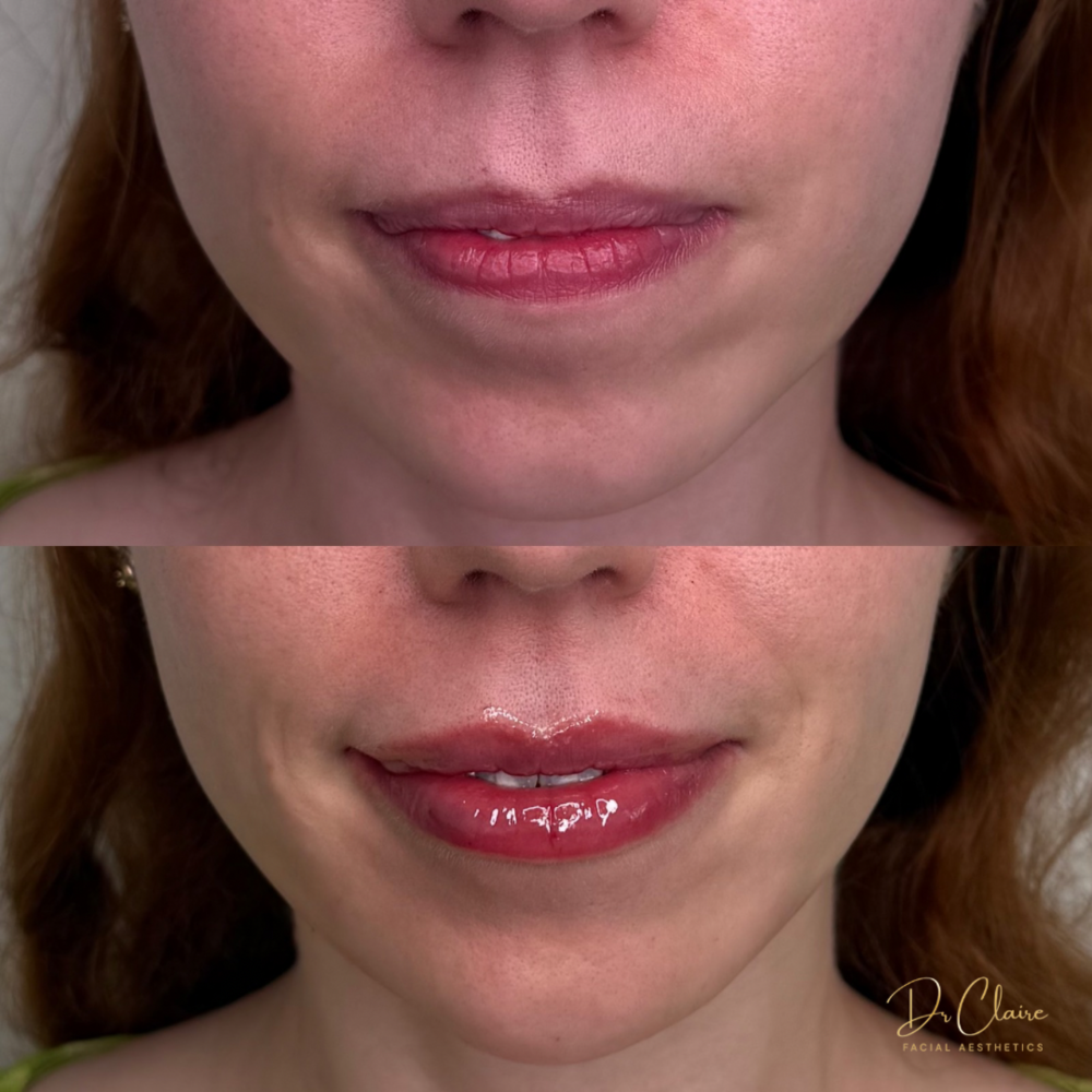 Transformations | Dr Claire Facial Aesthetics | Botox Chorley | Fillers Chorley | Aesthetics Chorley | Botox Treatments Chorley | Dermal Fillers Chorley | Aesthetic Enhancements Chorley