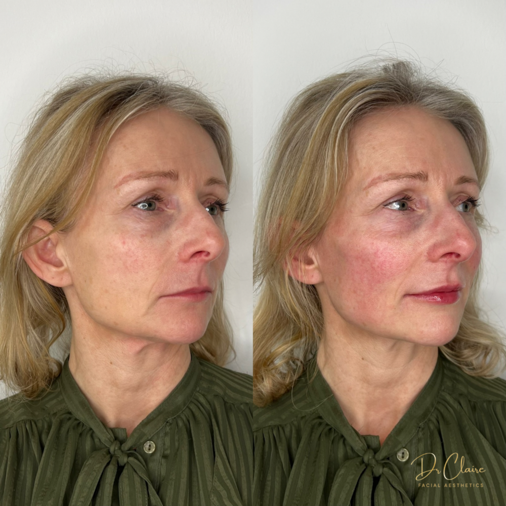 Transformations | Dr Claire Facial Aesthetics | Botox Chorley | Fillers Chorley | Aesthetics Chorley | Botox Treatments Chorley | Dermal Fillers Chorley | Aesthetic Enhancements Chorley