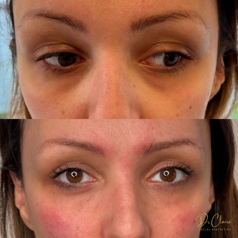 Transformations | Dr Claire Facial Aesthetics | Botox Chorley | Fillers Chorley | Aesthetics Chorley | Botox Treatments Chorley | Dermal Fillers Chorley | Aesthetic Enhancements Chorley